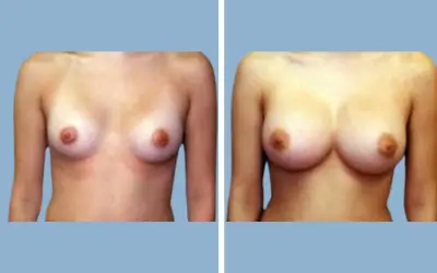 Before and After
